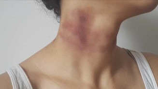 Woman's neck with severe bruising from strangulation